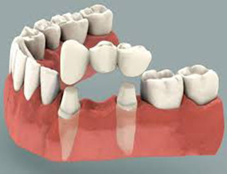 Dental Bridges