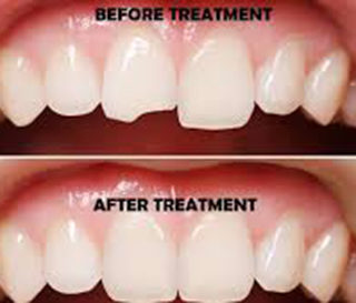 Broken or Chipped Teeth