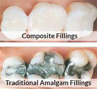 Dental Fillings (Cavity Correction)