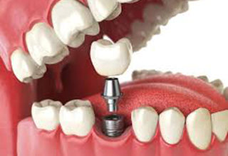 Dental Implants