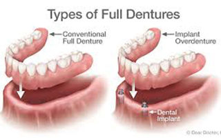 Dentures