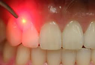 Laser Dentistry