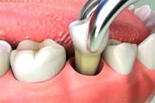 Teeth Extraction