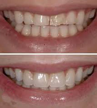 Veneers