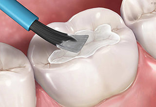 dental-sealants